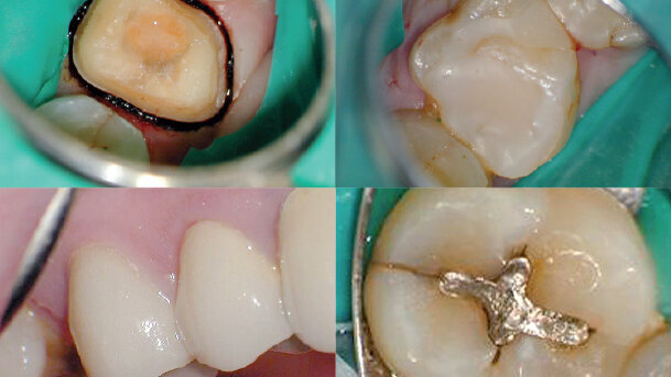 Techniky preparace na korunku za použití dentálního operačního mikroskopu