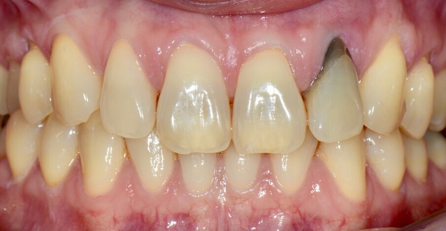 Fig. 1: Intra-oral pre-op situation of tooth #22, which had a horizontal fracture.