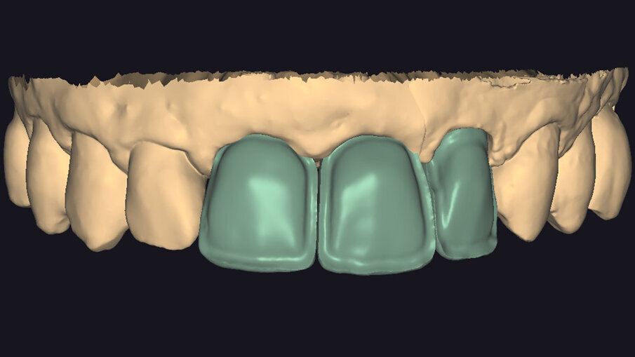 Fig. 6_Progetto della struttura definitiva con riduzione vestibolare.