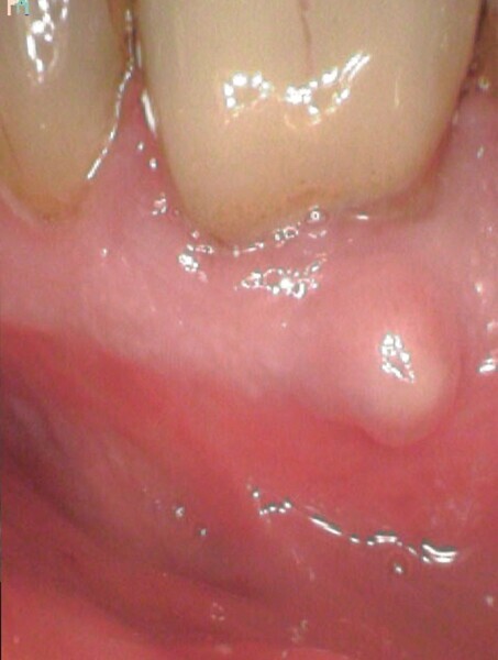 Fig. 8b : La fistule faisant face à la partie coronaire du canal radiculaire. 