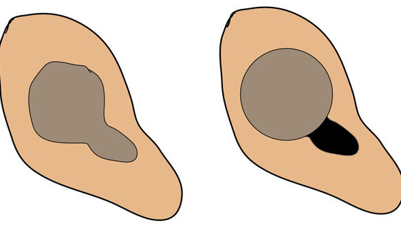 Canal anatomy as it relates to effective instrumentation and obturation