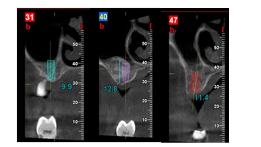 Fig. 5_CBCT a 5 mesi dal rialzo mascellare con approccio laterale.