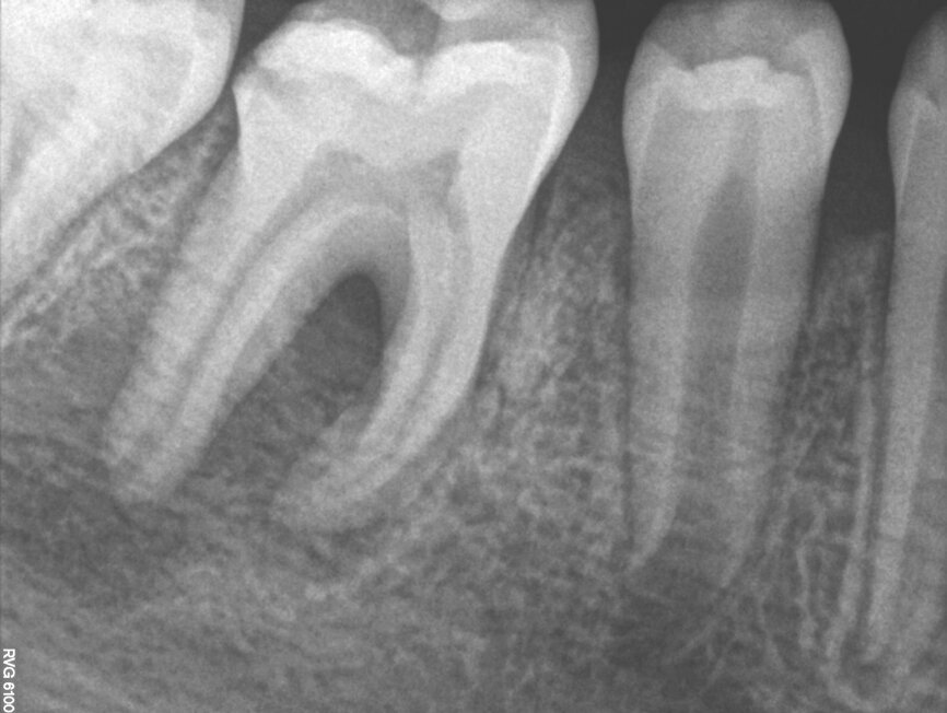 Fig. 3: Pre-op radiograph of tooth #46 showed a large area affected by periapical periodontitis going up into the furcation.