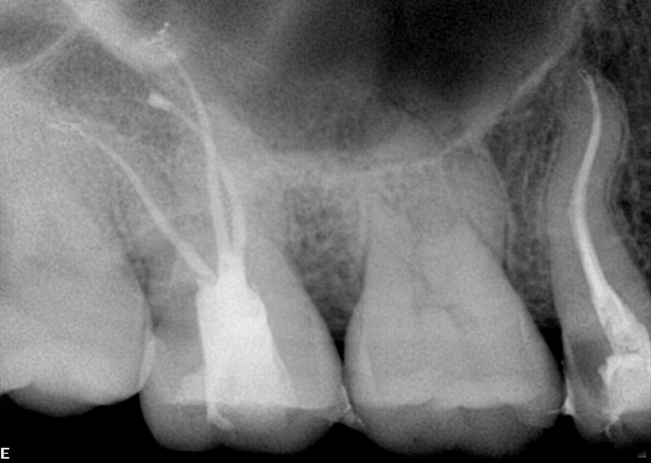 Fig. 5: Post-op periapical radiograph.