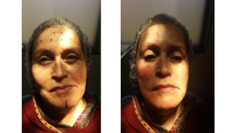 Foto 1. Foto inicial con marcas para tratamiento con Toxina Botulínica. Foto 2. Inicio de tratamiento de relleno en zona geniana derecha con ácido hialurónico de alto peso molecular (G). Aplicación de Toxina Botulínica.