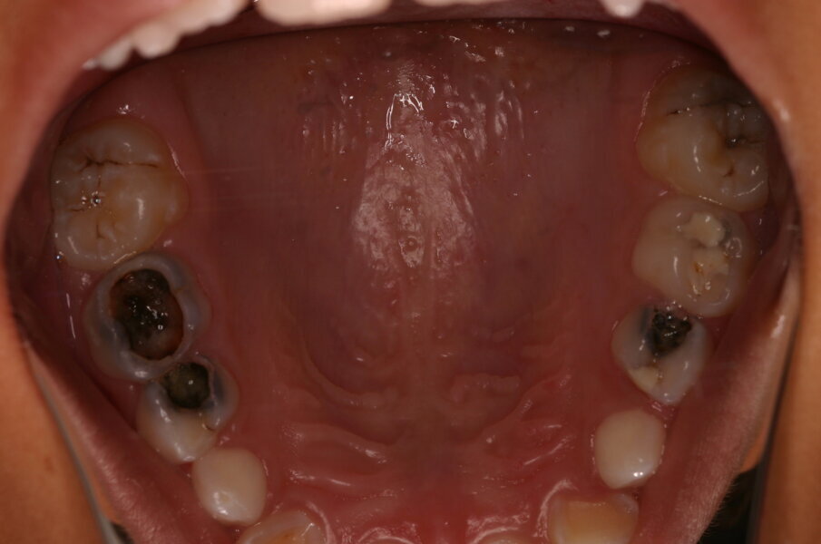 Afbeelding 6. Resultaat van de UCT-behandeling na twee jaar. De mond en caviteiten zijn schoon en het ziekteproces is tot stilstand gekomen. De ART-restauraties zien er goed uit.