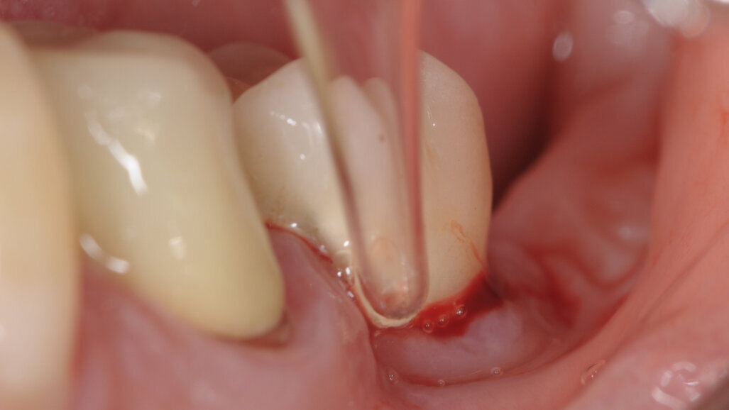 L’ozonoterapia nella gestione della Perimplantite: case report