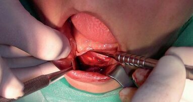 Miniimplanty systemu Bego-Semados na przykładzie klinicznym