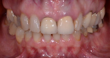 Restoring multiple teeth with a single multilayer zirconia Restoring multiple teeth with a single multilayer zirconia