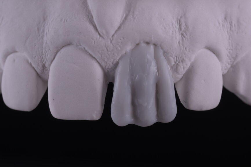 Fig. 23: Central lobe and incisal cones.