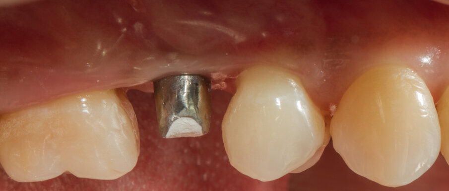Fig. 25 - Situazione tissutale dopo 2 mesi di provvisorizzazione.