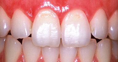 Füllungen im Zahnhalsbereich – mit dem Laser im Vorteil (Teil 1)