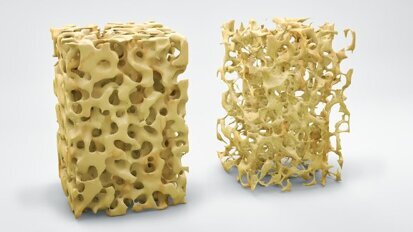 Osteoporose: Implantes de magnésio que dissolvem podem promover a formação óssea