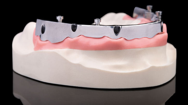 La barra in titanio è avvitata agli impianti e, a sua volta, la struttura secondaria è avvitata alla barra, consentendo di evitare canali vestibolari antiestetici nella regione anteriore e di migliorare la cura e l’igiene postoperatoria.