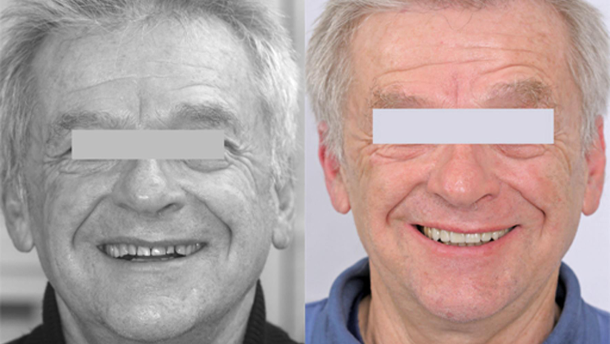 Daily work with Coachman’s Digital Smile Design protocol