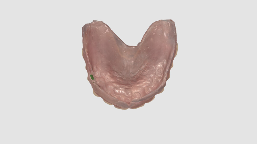 Fig. 6_Stessa impronta, con acquisizione della base interna della protesi per ottenere un duplicato digitale accurato.