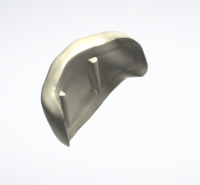 Fig. 10: Veneer, fitting surface.