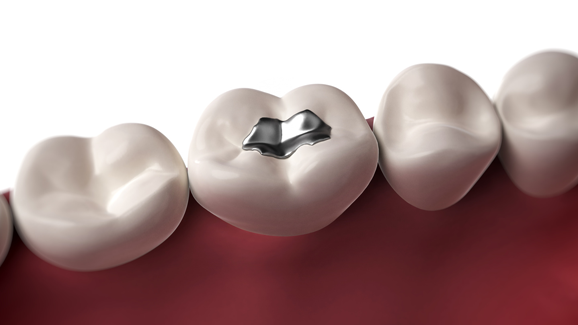 Komplettes Amalgamverbot nicht angestrebt