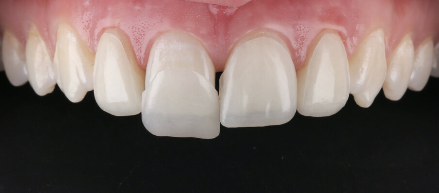 Fig. 6: Try-in of the milled mockup-veneers.