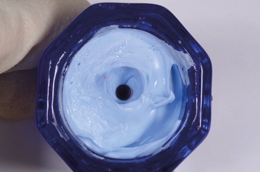Fig. 16 : Le godet Dappen est rempli avec un matériau d’empreinte en silicone pour reproduire le profil d’émergence de la dent provisoire personnalisée. 