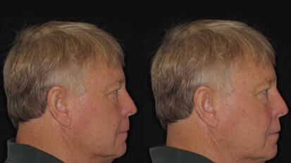 Проучване: не е нужно пациентите да правят компромис с външния си вид при избор на протеза