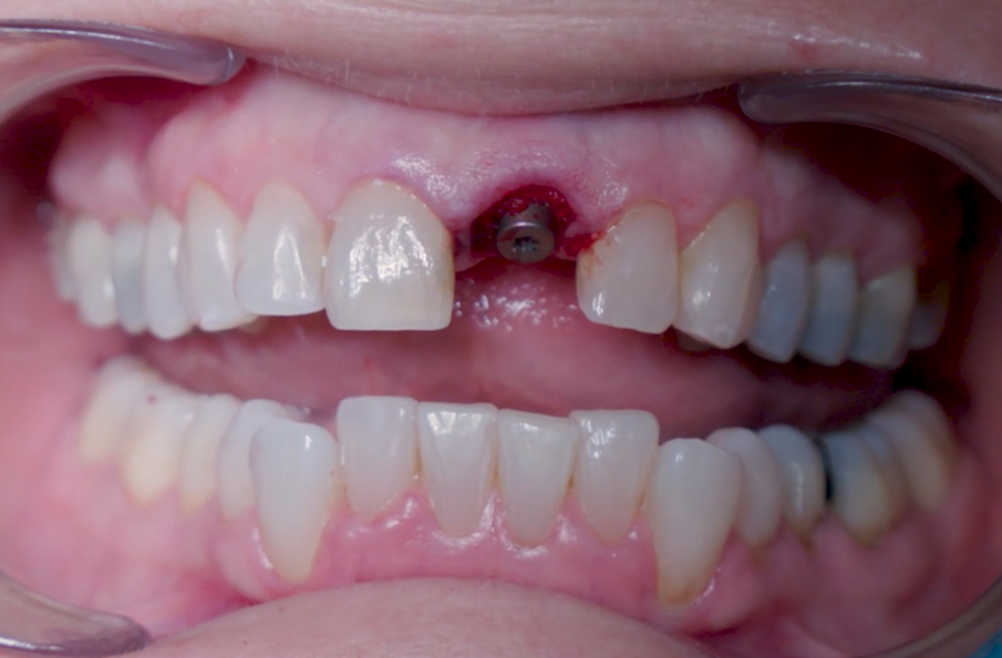 Fig. 18_Applicazione biomateriale finalizzata.