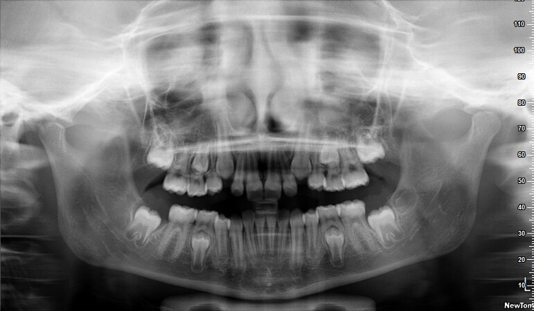 Fig. 8_Ortopantomografia, correzione del percorso eruttivo di 1.3-2.3.
