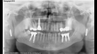Míra úspěšnosti dentálních implantátů u těžkých kuřáků. Dlouhodobá studie