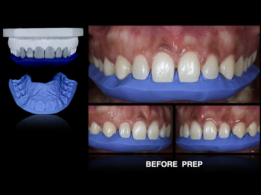 Fig. 52: The palatal-incisal
silicone index was used to establish the space on the incisal margin. Steps before, during and after preparation.