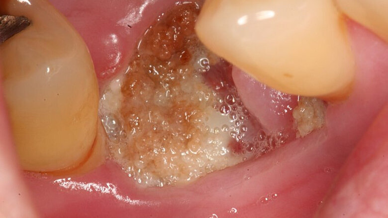 Study presents new treatment for jaw osteonecrosis around dental implants
