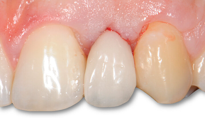 Fig. 6a - Corona cementata.