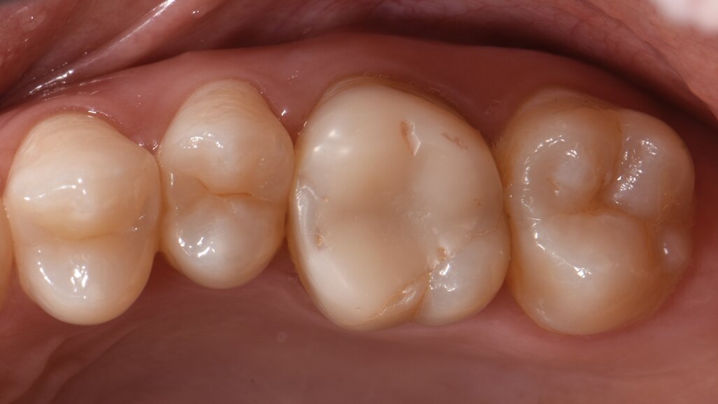 A biomimetic approach to restoration after endodontic treatment