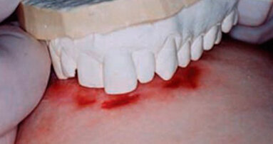 “Piano con l’attribuire ai morsi il valore di prova” dicono i ricercatori americani di Medicina legale