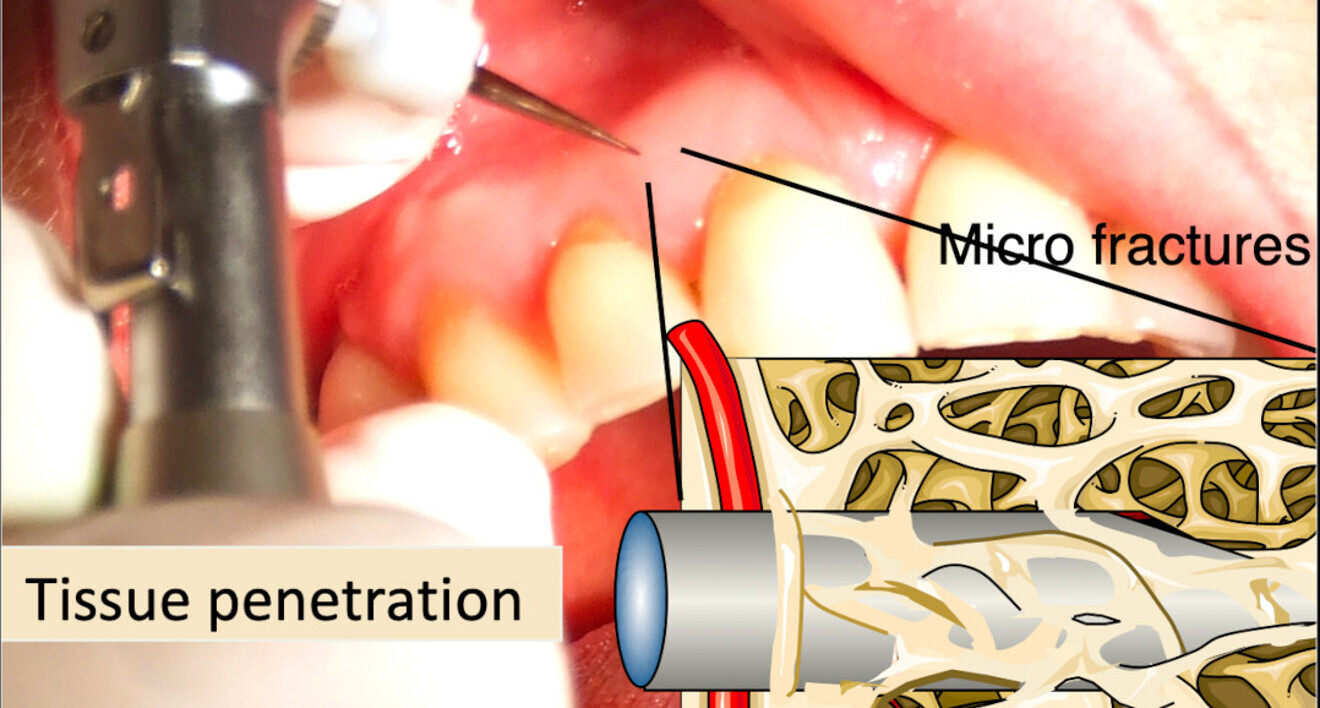 Fig. 2 : L’ostéotension provoque mécaniquement des micro-fractures.Ostéo-activation : dix-neuf ans de recul.