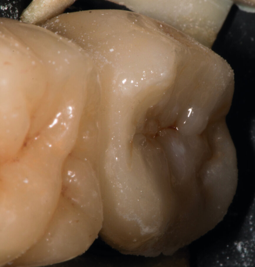 Fig. 16 : Mise en forme et modelage au moyen d’un pinceau GRADIA de GC. 