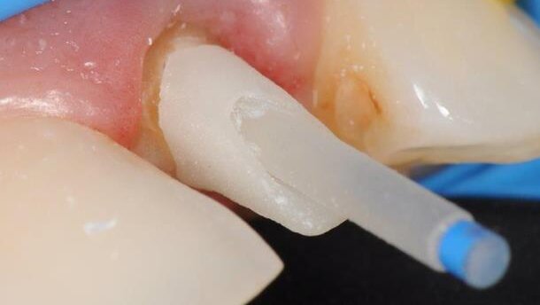 Wkłady koronowo-korzeniowe a ostateczny efekt estetycznego leczenia protetycznego