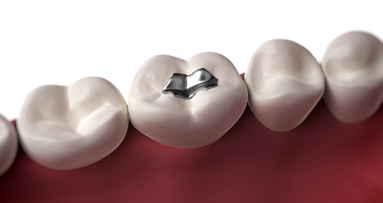 Komplettes Amalgamverbot nicht angestrebt