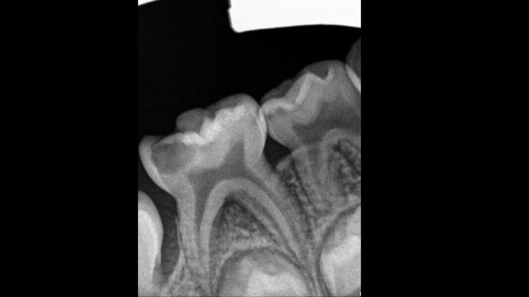 Fig. 2: Deep cavity and bone loss in the furcal area.