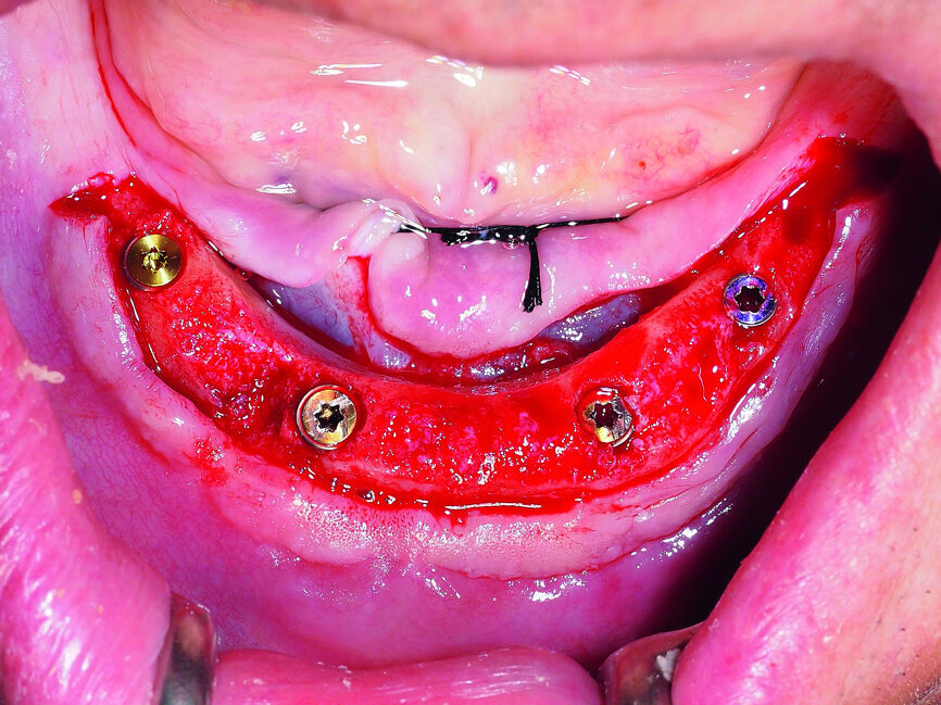 Fig. 2: Placement of four GC Aadva implants in the interforaminal region.