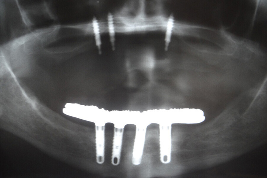 Fig. 13. Prótesis híbrida inmediata con 6 años de evolución y Rx Control a los 6 años.