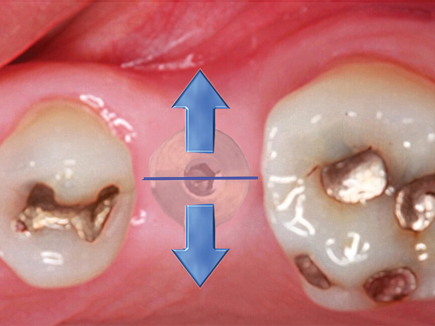 Fig. 5: When minimal keratinized gingiva is present, the diode laser is utilized to make an incision distal-mesially, and the tissue is spread conserving all of the attached gingiva present. (Photo provided by Dr. Gregori M. Kurtzman)