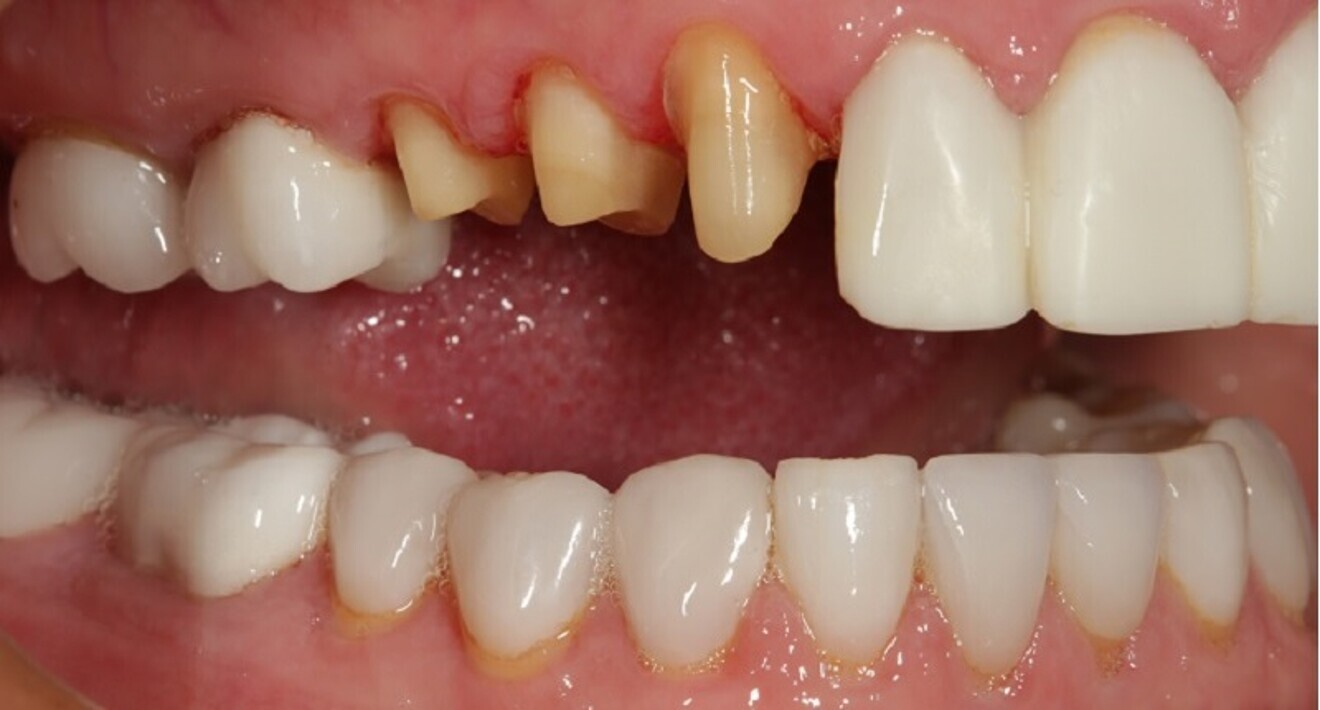 Fig. 6: Situation after removal of the provisional restorations on the maxillary right side prior to placement of the PMMA prototype restorations.