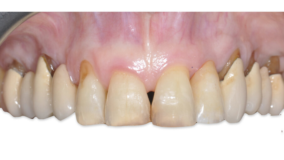 Fig. 15_Consegna della corona ceramica avvitata.