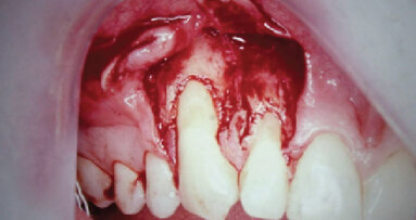 Překrytí gingiválních recesů se stalo předvídatelné díky použití resorbovatelných bariér