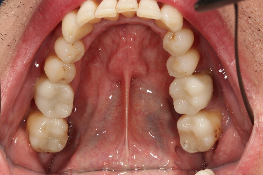 Fig. 10a: Occlusal view after the treatment: glass-ceramic crowns (a), composite fillings and a bridge of lithium disilicate (b).