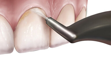 Erythritol functional roles in  oral-systemic health