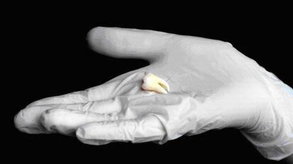 Nieuwe forensische tandentest maakt leeftijdsbepaling preciezer dan ooit