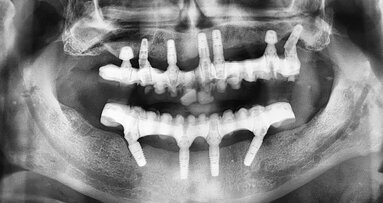 Kombinace standardních a ultrakrátkých implantátů při rehabilitaci celých úst