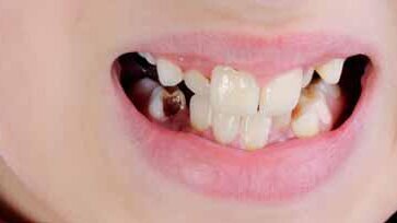 30% rodziców pozwala swoim dzieciom na zaniedbywanie higieny jamy ustnej