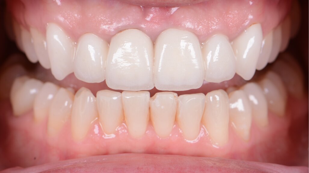 A bright new smile with KATANA Zirconia YML